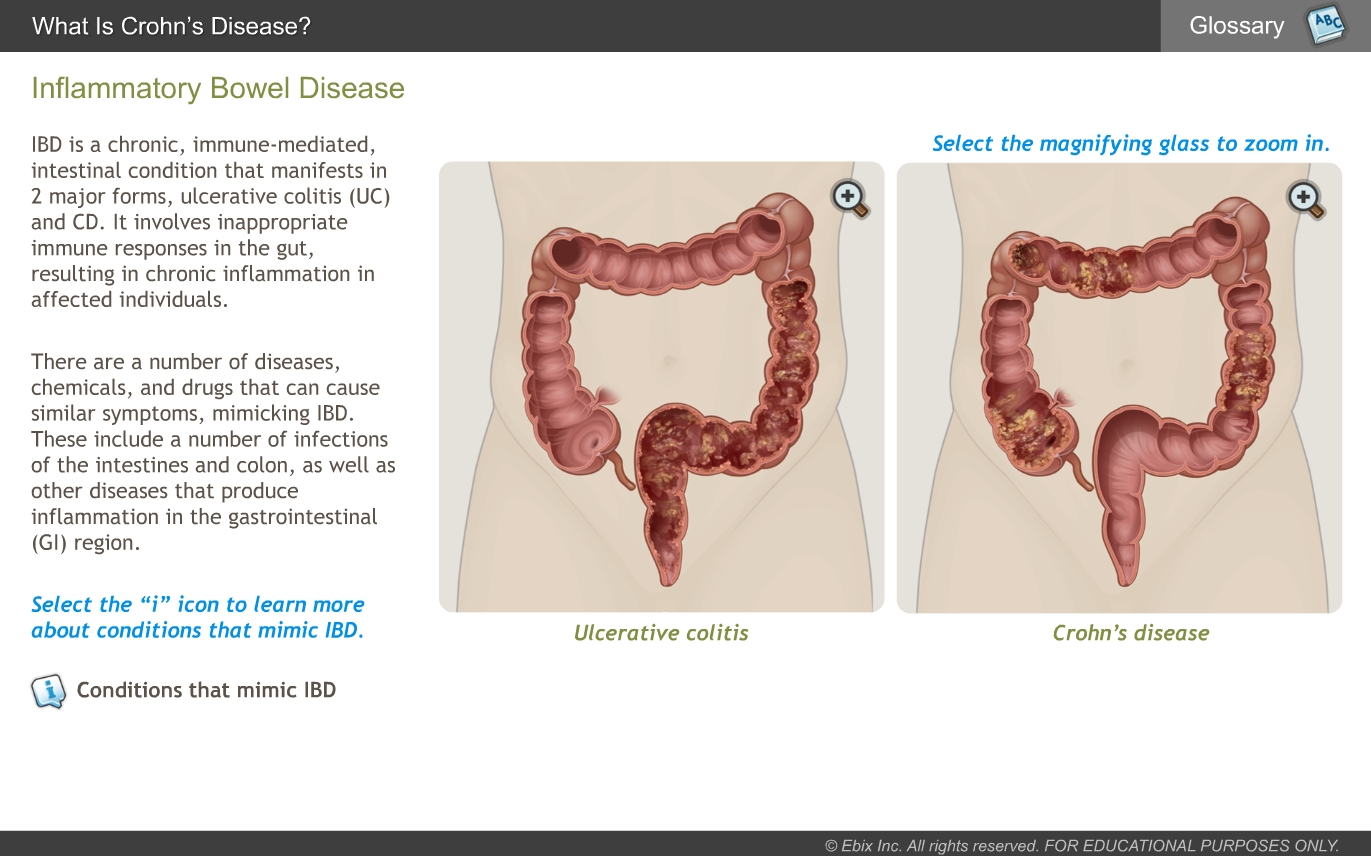 Inflammatory-Bowel-Disease